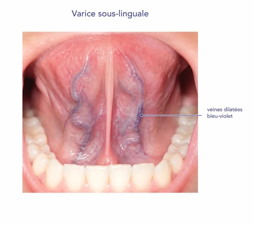 Photo varice sous la langue montrant un cordon veineux bleu-violet sur la face ventrale de la langue